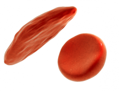 Stem Cell Transplantation for Sickle Cell Anemia – Saudi Experience